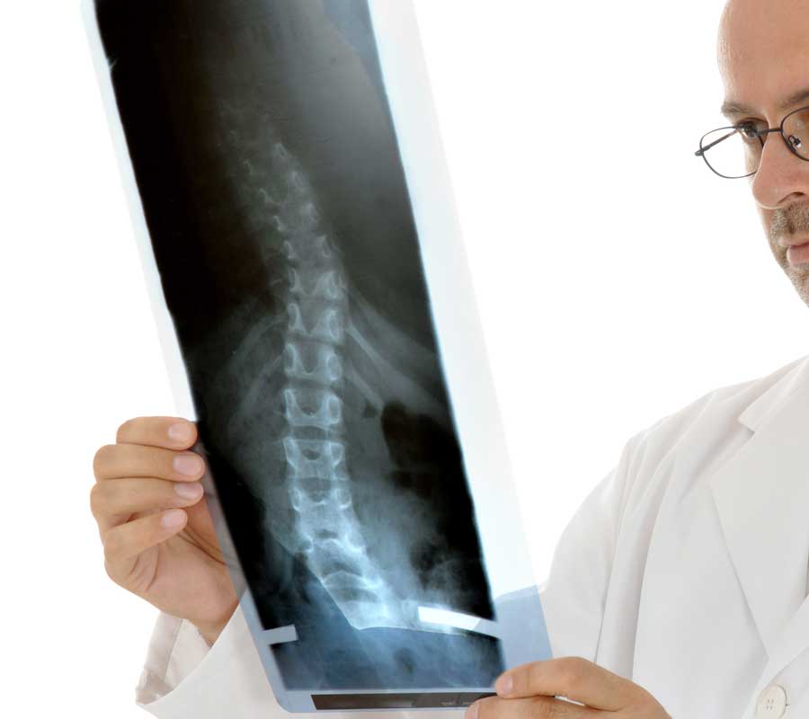 Breaking Down the Braces Used to Correct Scoliosis – Chiropractic